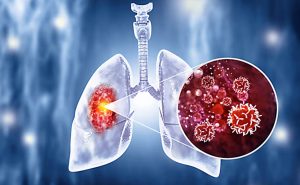 Rak wraca częściej u młodych